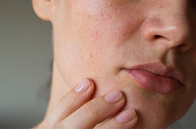 Characteristics and Causes - Acne